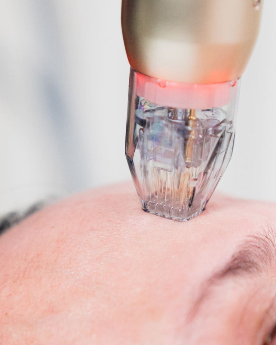 Person receiving a laser treatment on their forehead with a blurred background